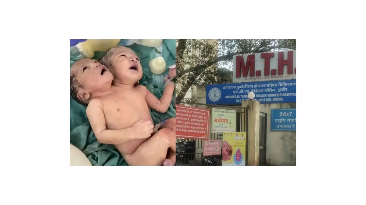 इंदौर में जन्मे दुर्लभ जुड़वां बच्चे, दो सिर, साझा शरीर; चिकित्सा जगत अचंभित