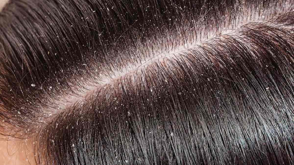 सर्दियों में बालों की डैंड्रफ और खुजली को कहें अलविदा, अपनाएं ये आसान टिप्स