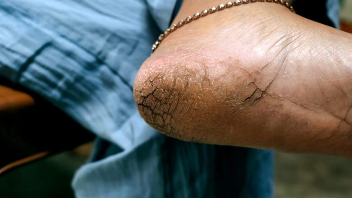 महंगे प्रोडक्ट्स भूल जाएँ, पाए सर्दियों में फटी एड़ियों से छुटकारा; जानें आसान घरेलू नुस्खे