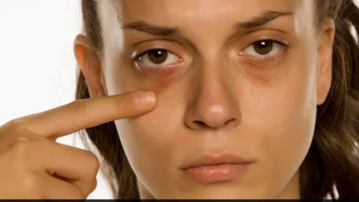 डार्क सर्कल्स सिर्फ सुंदरता की नहीं, बल्कि स्वास्थ्य की भी देती है चेतावनी; जानिए इसके कारण और समाधान के उपाय