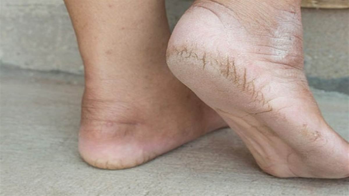 सर्दियों में फटी एड़ियों को कहें अलविदा, अपनाएं ये आसान घरेलू नुस्खे