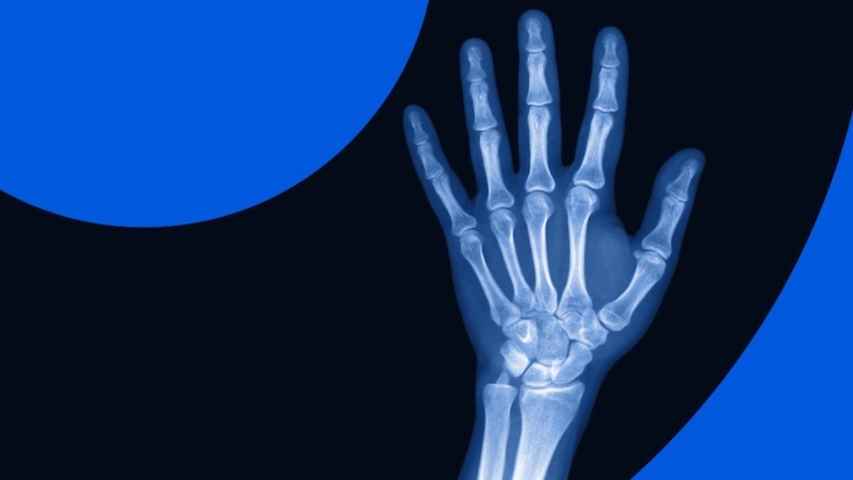 एलन मस्क का दावा, एक्स-रे से बीमारी पहचान सकता है Grok; मेडिकल दुनिया में मचा हड़कंप